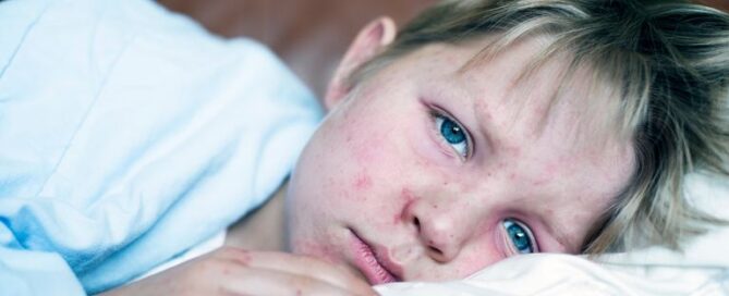 O sarampo é uma doença que afeta principalmente crianças até 4 anos